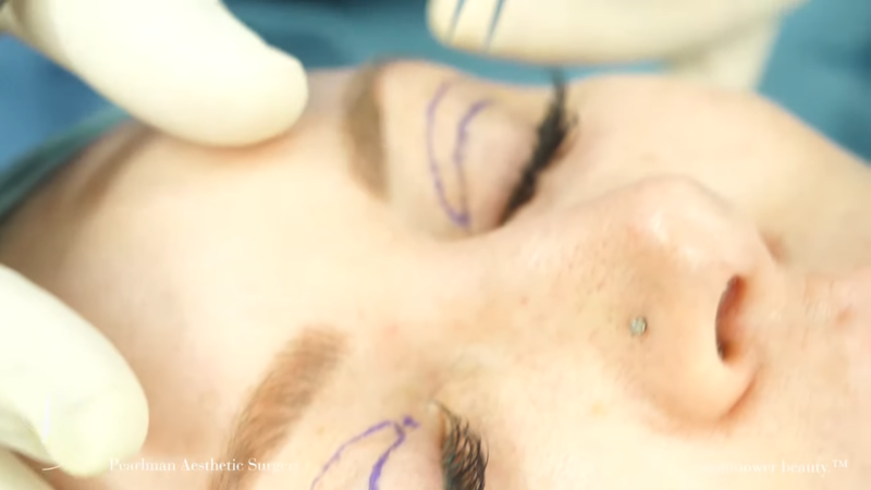 Upper Eyelid Blepharoplasty